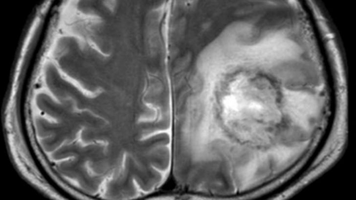 https://www.salarnews.in/public/uploads/images/newsimages/maannewsimage19082025_131333_Amoebic encephalitis.jpg
